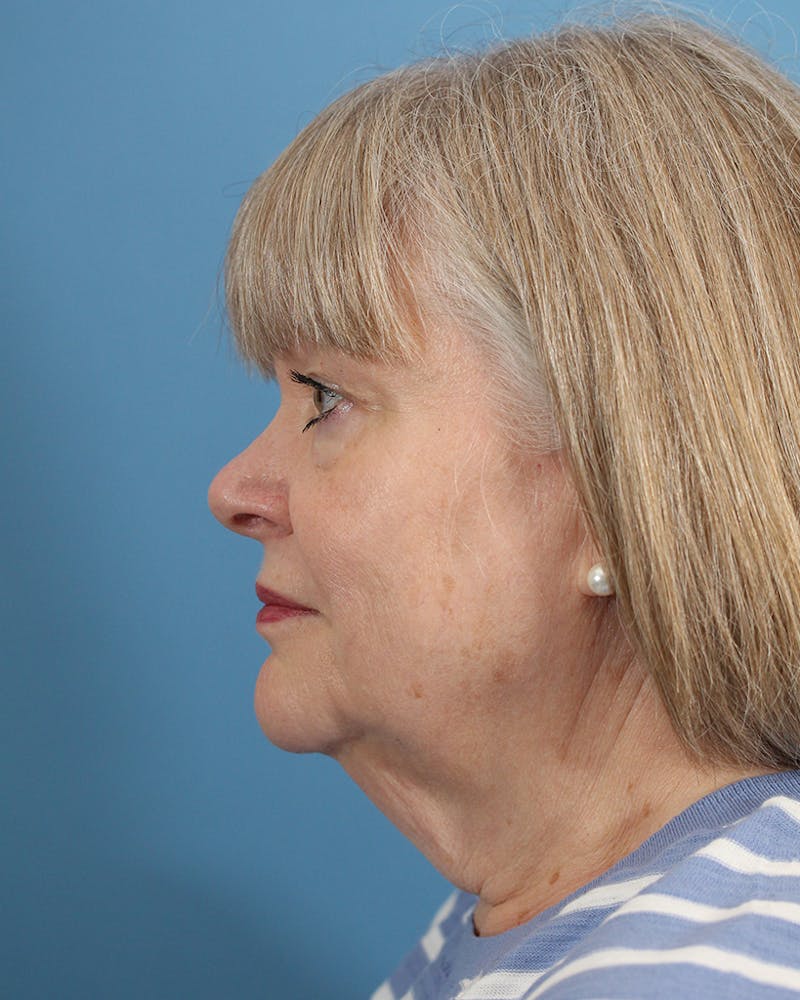 Facelift/Neck Lift Before & After Gallery - Patient 48085348 - Image 5