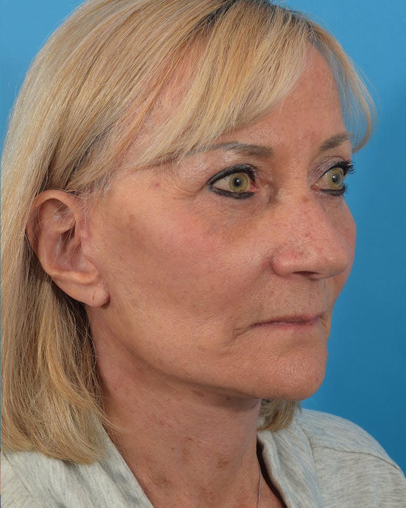 Facelift/Neck Lift Before & After Gallery - Patient 48085347 - Image 6