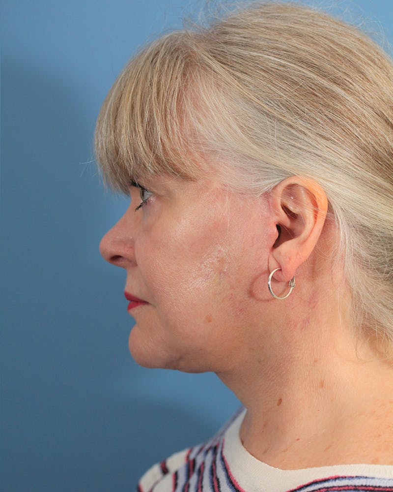 Facelift/Neck Lift Before & After Gallery - Patient 48085348 - Image 6