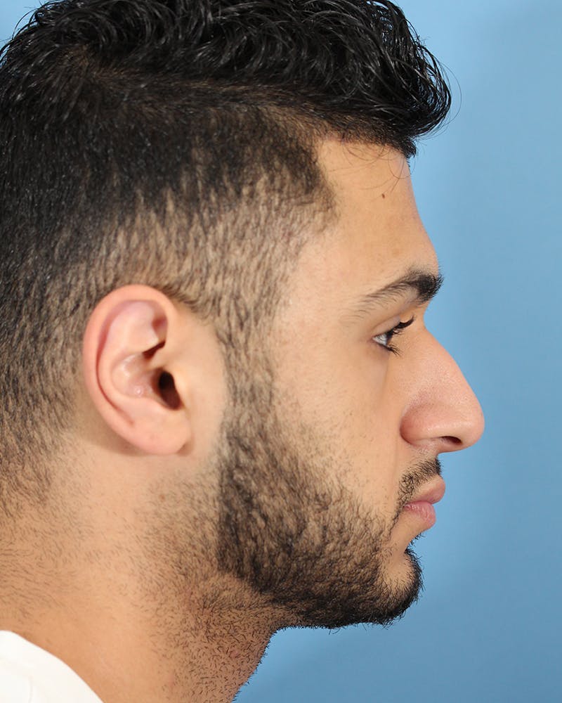Rhinoplasty Before & After Gallery - Patient 49967057 - Image 1