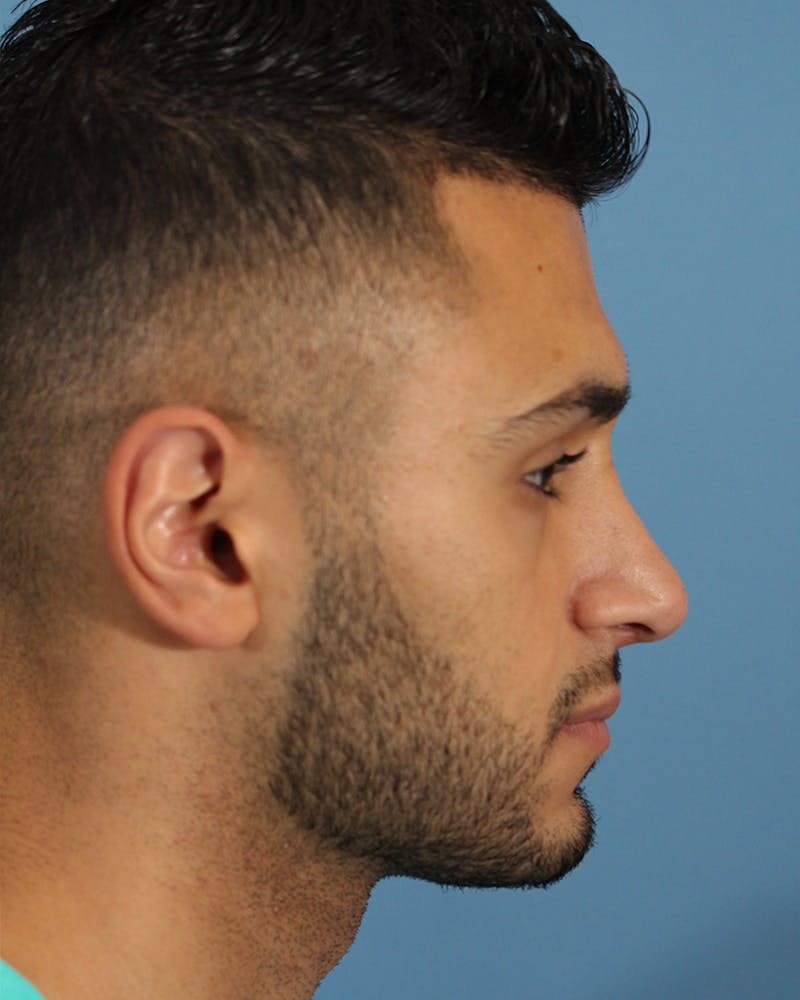 Rhinoplasty Before & After Gallery - Patient 49967057 - Image 2