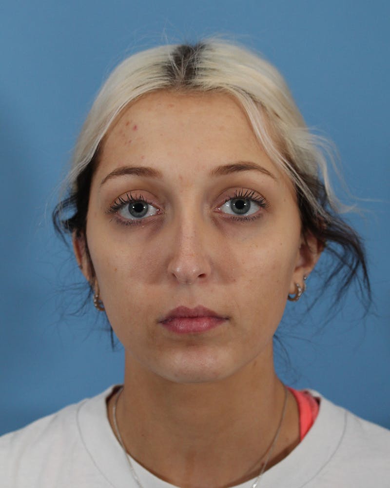 Rhinoplasty Before & After Gallery - Patient 51235332 - Image 3