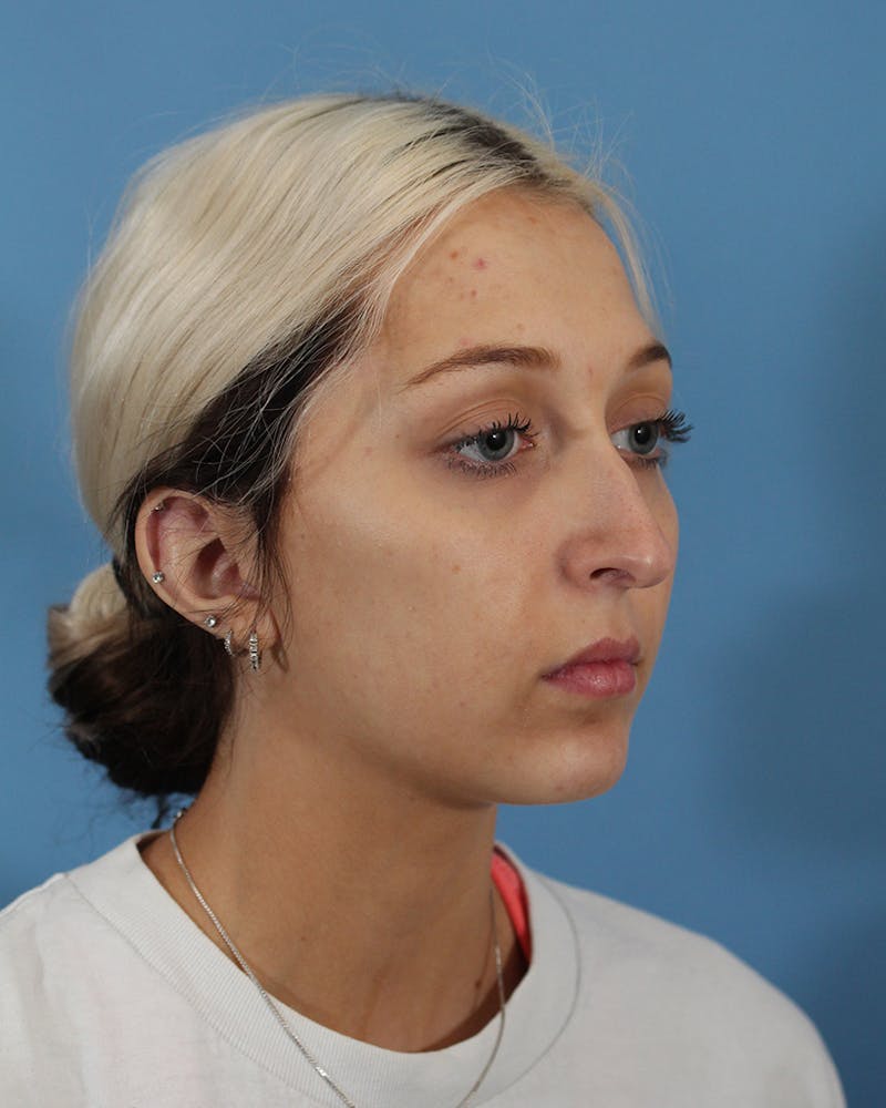 Dr. Frankel's Rhinoplasty in Cleveland Before and After 03