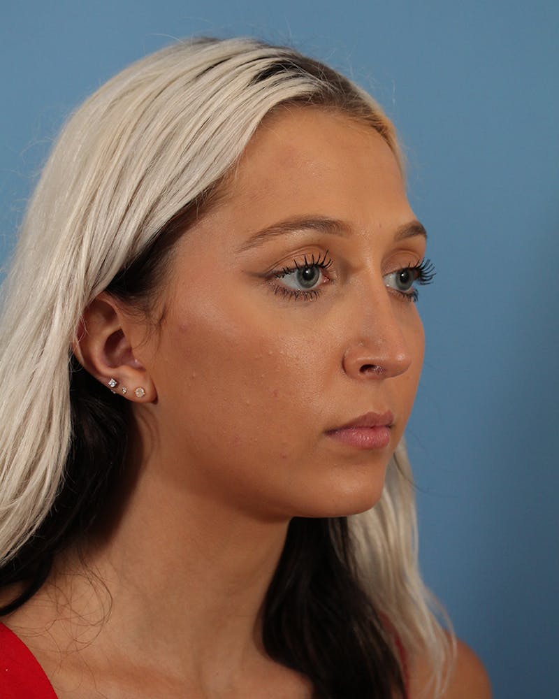 Dr. Frankel's Rhinoplasty in Cleveland Before and After 03