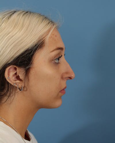 Rhinoplasty Before & After Gallery - Patient 51235332 - Image 1