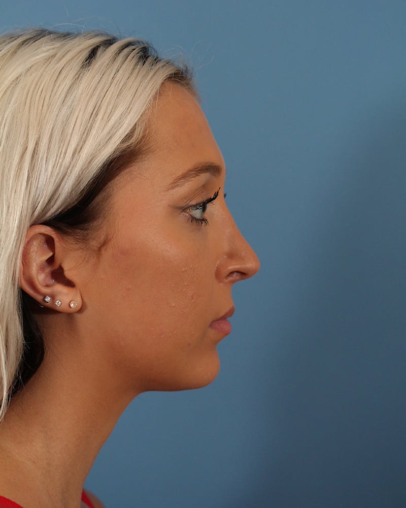 Rhinoplasty Before & After Gallery - Patient 51235332 - Image 2