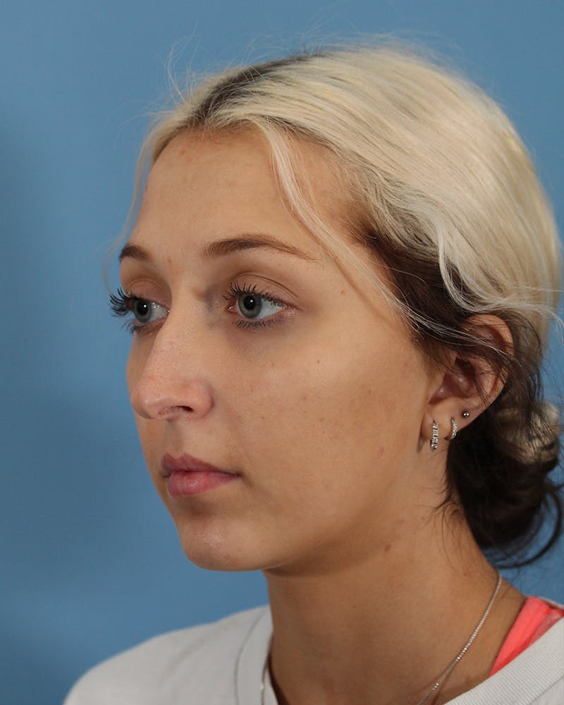 Rhinoplasty Before & After Gallery - Patient 51235332 - Image 7