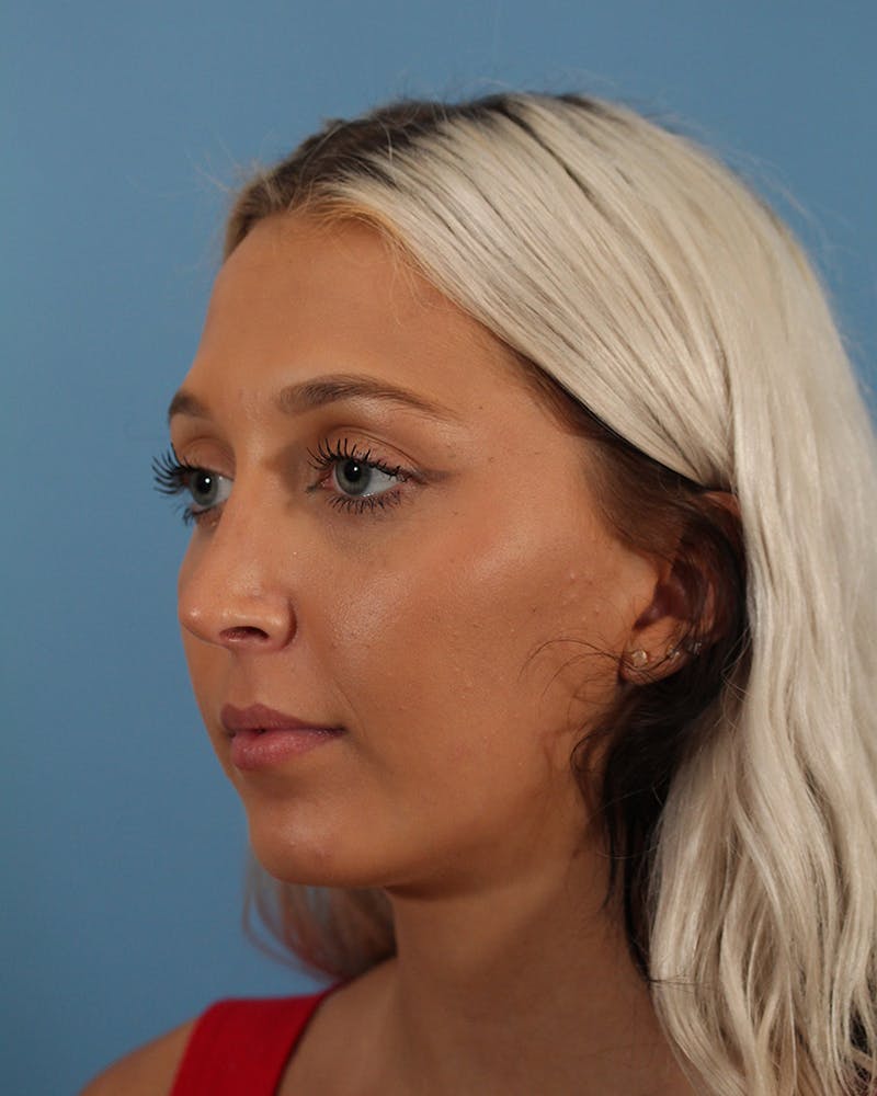 Rhinoplasty Before & After Gallery - Patient 51235332 - Image 8