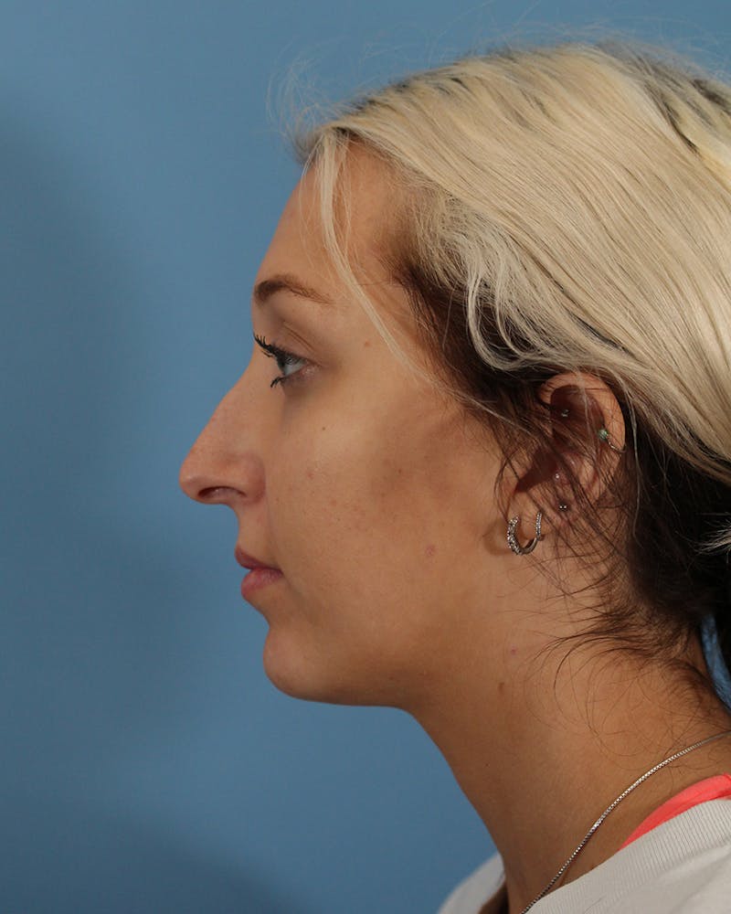 Rhinoplasty Before & After Gallery - Patient 51235332 - Image 9