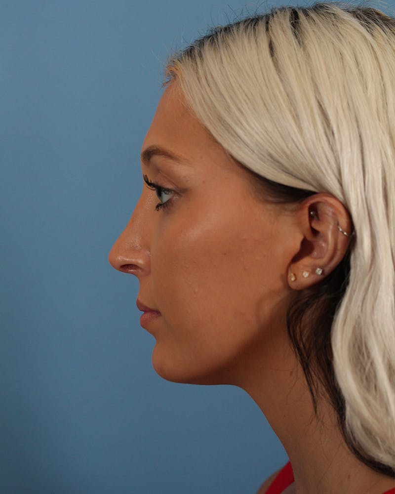 Rhinoplasty Before & After Gallery - Patient 51235332 - Image 10