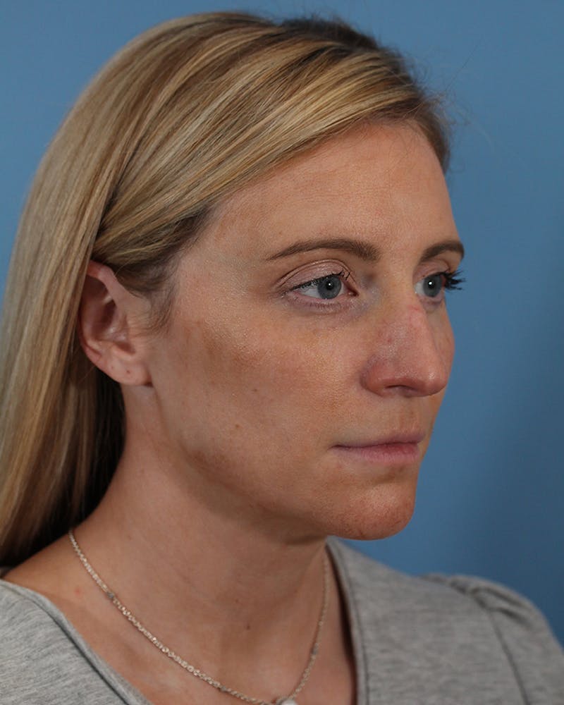Rhinoplasty Before & After Gallery - Patient 51235331 - Image 3