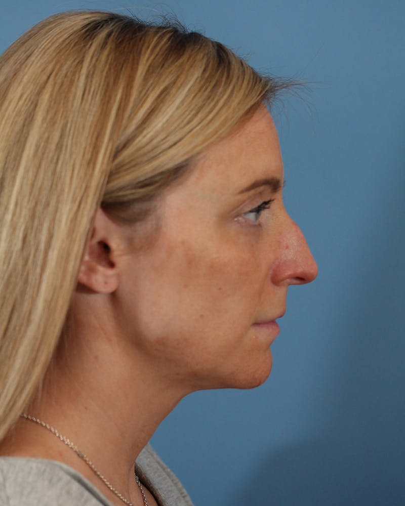 Rhinoplasty Before & After Gallery - Patient 51235331 - Image 1