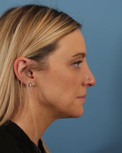 Rhinoplasty Before & After Gallery - Patient 51235331 - Image 2