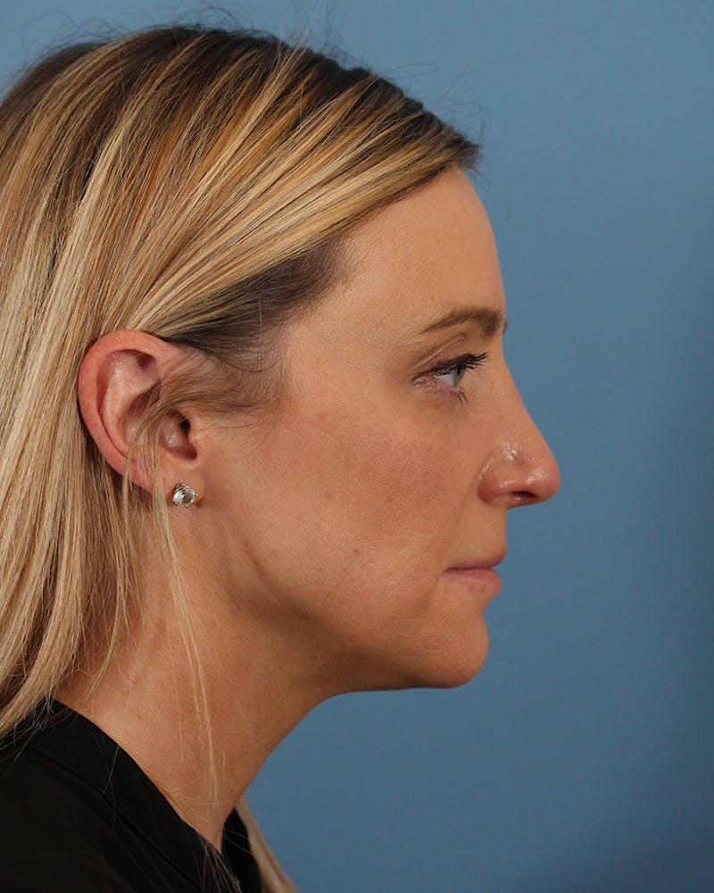 Rhinoplasty Before & After Gallery - Patient 51235331 - Image 2