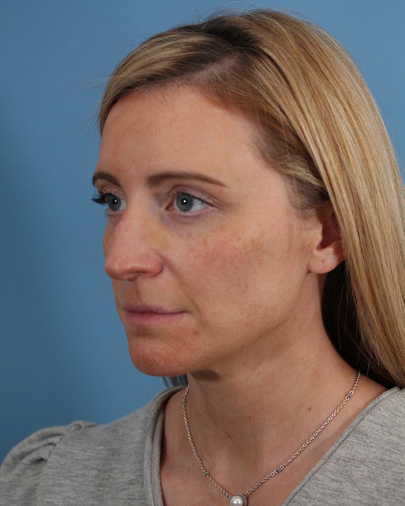 Rhinoplasty Before & After Gallery - Patient 51235331 - Image 5