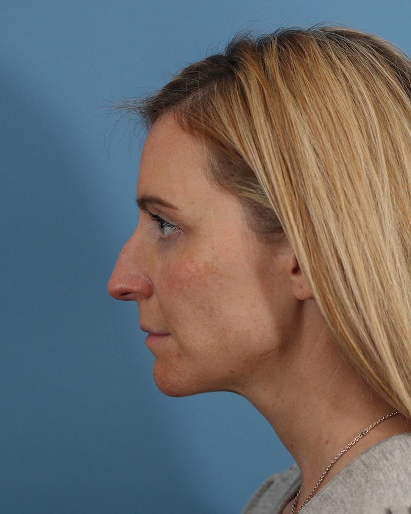 Rhinoplasty Before & After Gallery - Patient 51235331 - Image 7