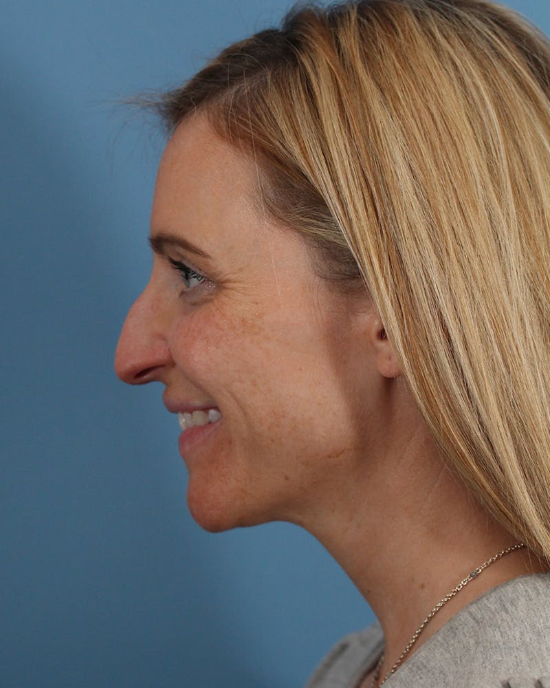 Rhinoplasty Before & After Gallery - Patient 51235331 - Image 9