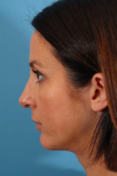 Chin Augmentation Before & After Gallery - Patient 53572525 - Image 2