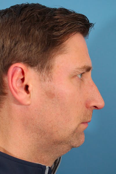 Chin Augmentation Before & After Gallery - Patient 53572526 - Image 1