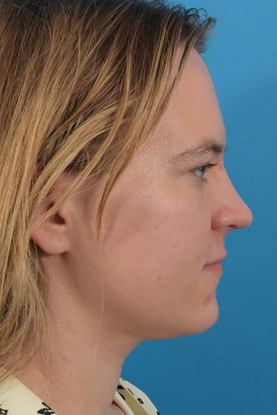 Submental Liposuction Before & After Gallery - Patient 53572723 - Image 1