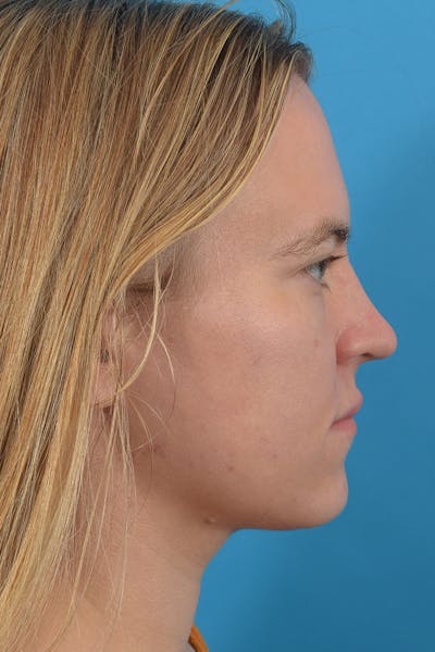Submental Liposuction Before & After Gallery - Patient 53572723 - Image 2