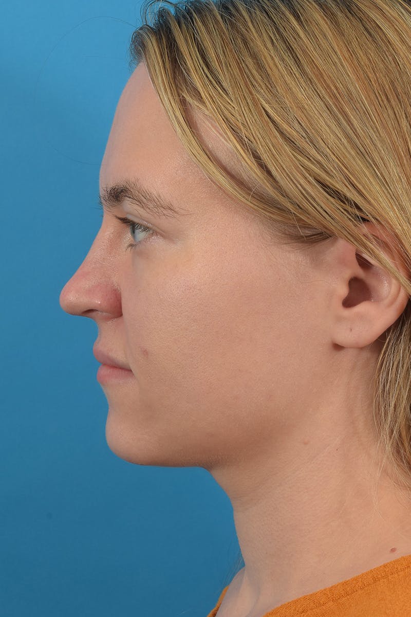 Submental Liposuction Before & After Gallery - Patient 53572723 - Image 4