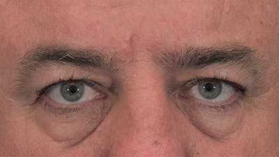 Blepharoplasty Before & After Gallery - Patient 56163378 - Image 1