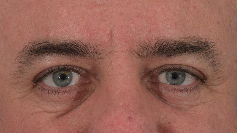 Blepharoplasty Before & After Gallery - Patient 56163378 - Image 2