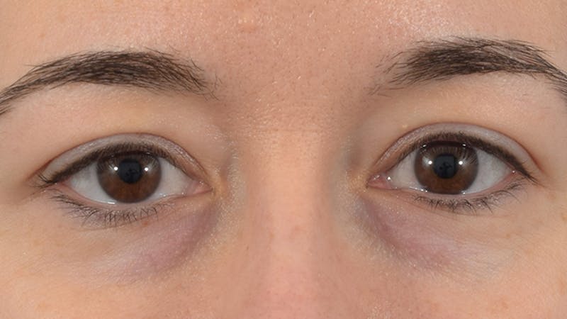 Blepharoplasty Before & After Gallery - Patient 57014134 - Image 1