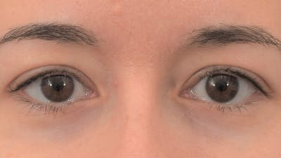 Blepharoplasty Before & After Gallery - Patient 57014134 - Image 2