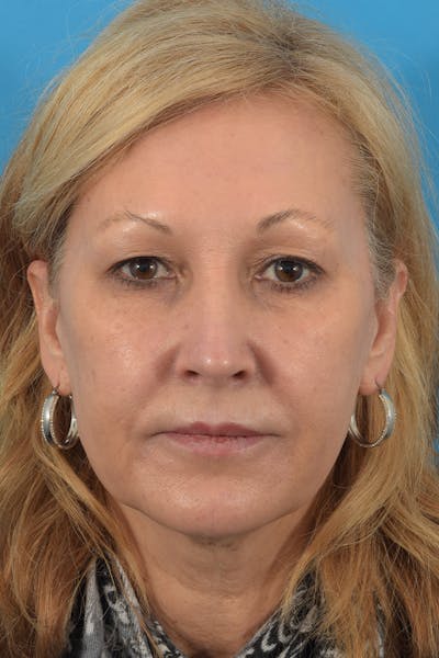 Facelift/Neck Lift Before & After Gallery - Patient 40544183 - Image 1