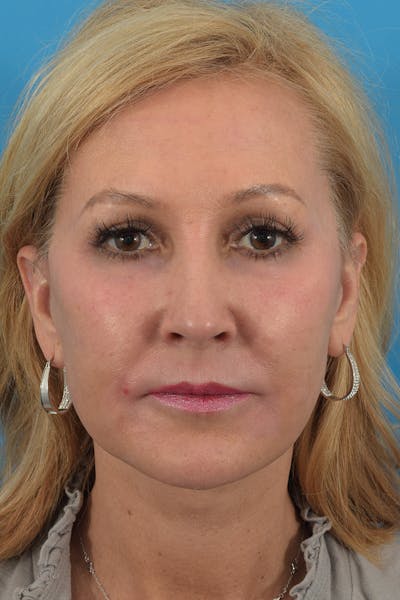 Blepharoplasty Before & After Gallery - Patient 57583681 - Image 2
