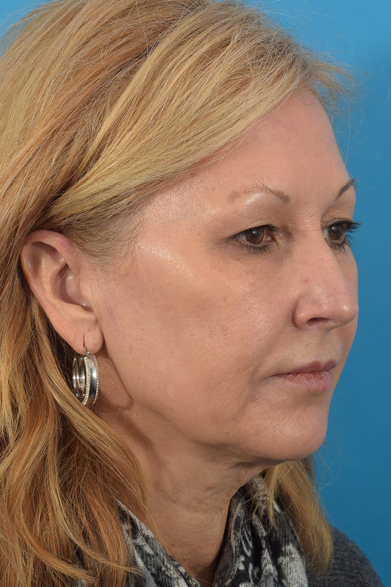 Chemical Peel Before & After Gallery - Patient 141526128 - Image 3