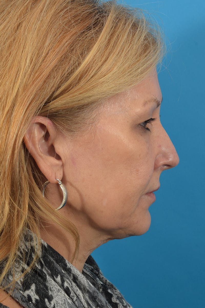 Facelift/Neck Lift Before & After Gallery - Patient 40544183 - Image 5