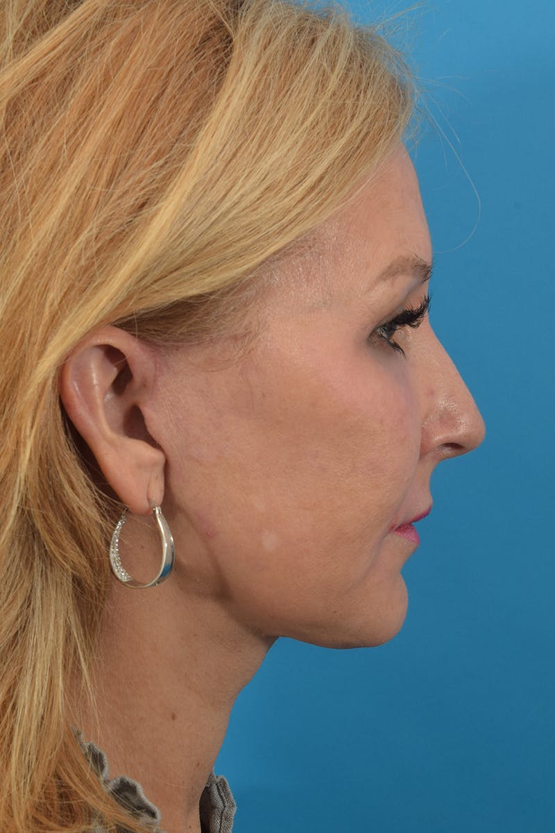 Facelift/Neck Lift Before & After Gallery - Patient 40544183 - Image 6