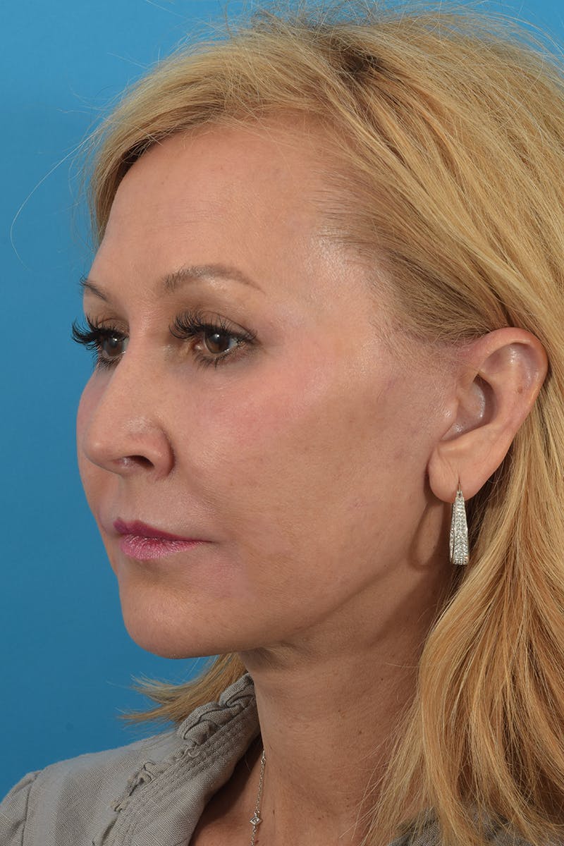 Facelift/Neck Lift Before & After Gallery - Patient 40544183 - Image 8