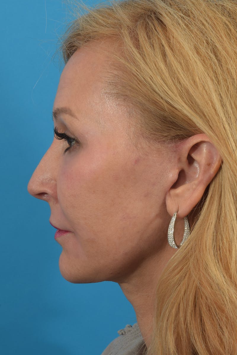 Facelift/Neck Lift Before & After Gallery - Patient 40544183 - Image 10