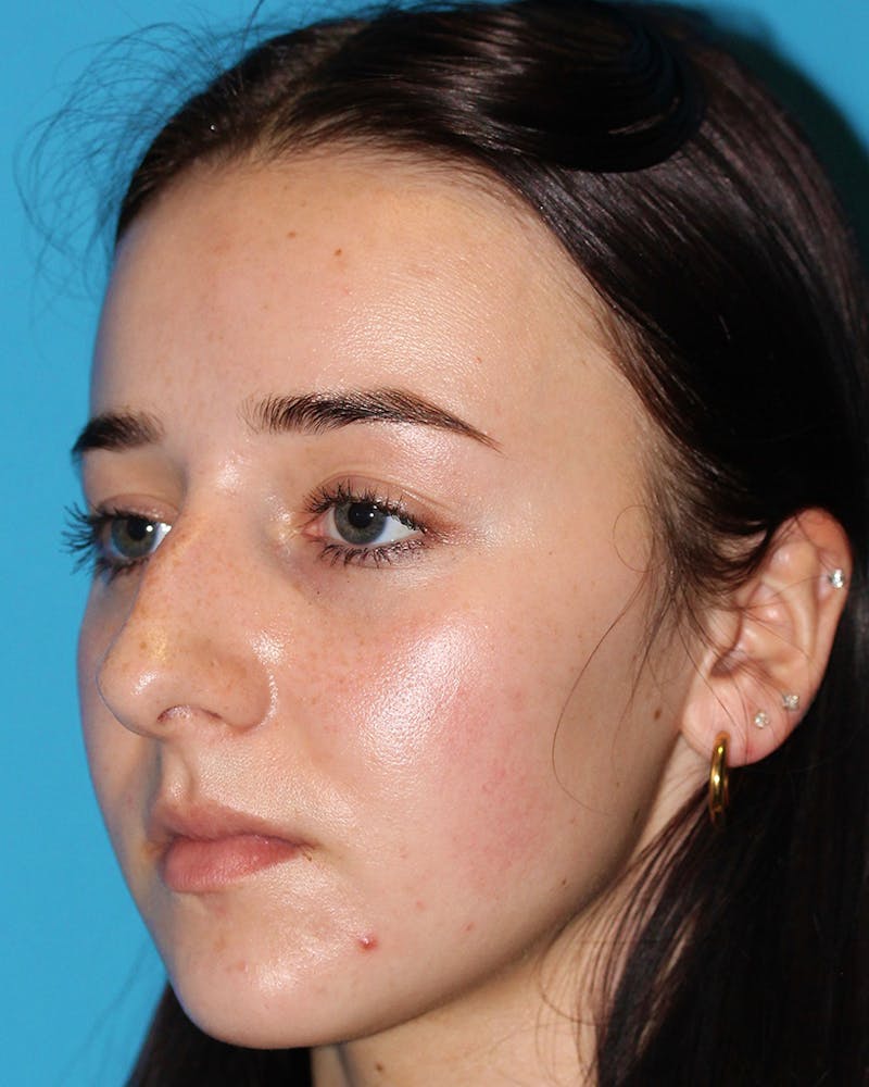Rhinoplasty Before & After Gallery - Patient 59449452 - Image 3