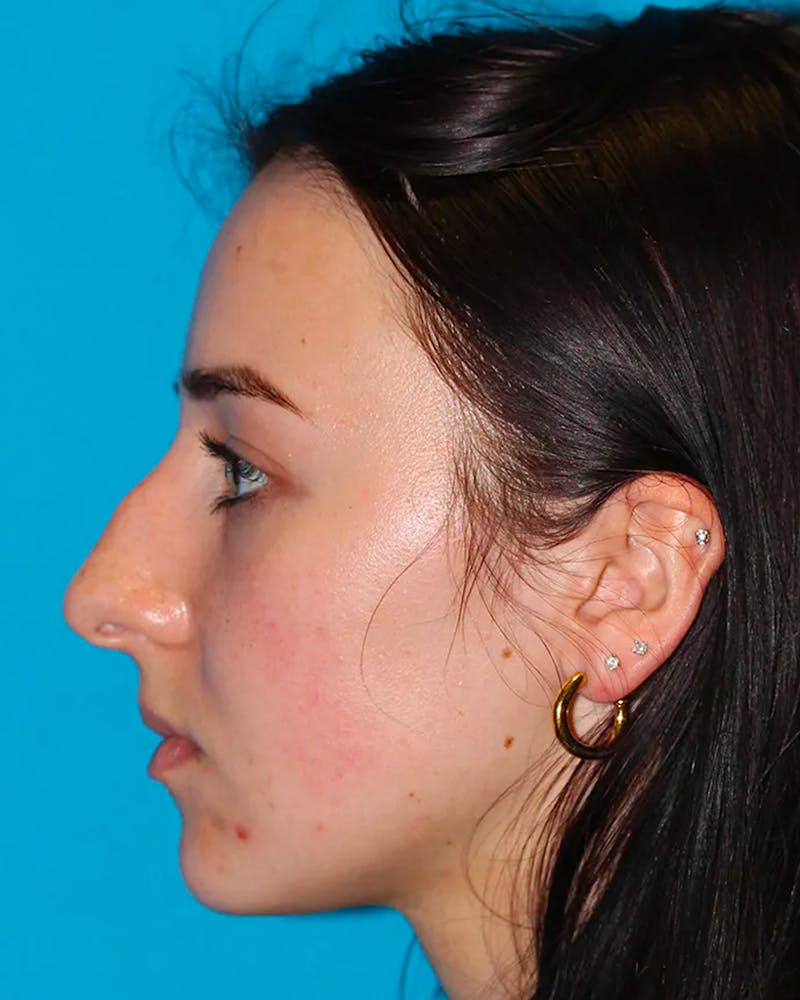 Dr. Frankel's Rhinoplasty in Cleveland Before and After 04