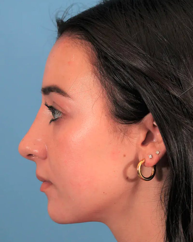 Dr. Frankel's Rhinoplasty in Cleveland Before and After 04