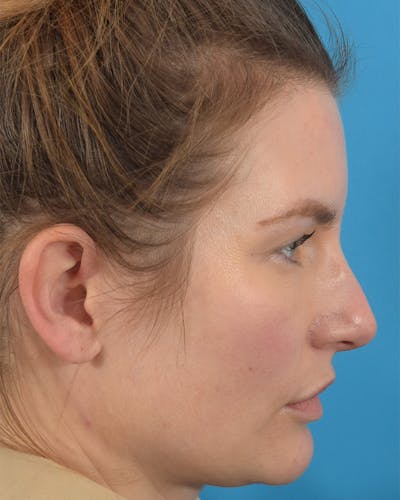 Rhinoplasty Before & After Gallery - Patient 62576199 - Image 1