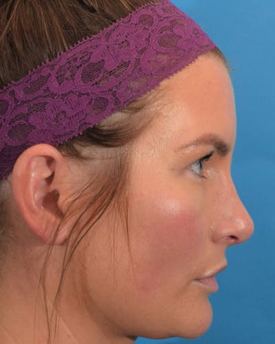 Rhinoplasty Before & After Gallery - Patient 62576199 - Image 2