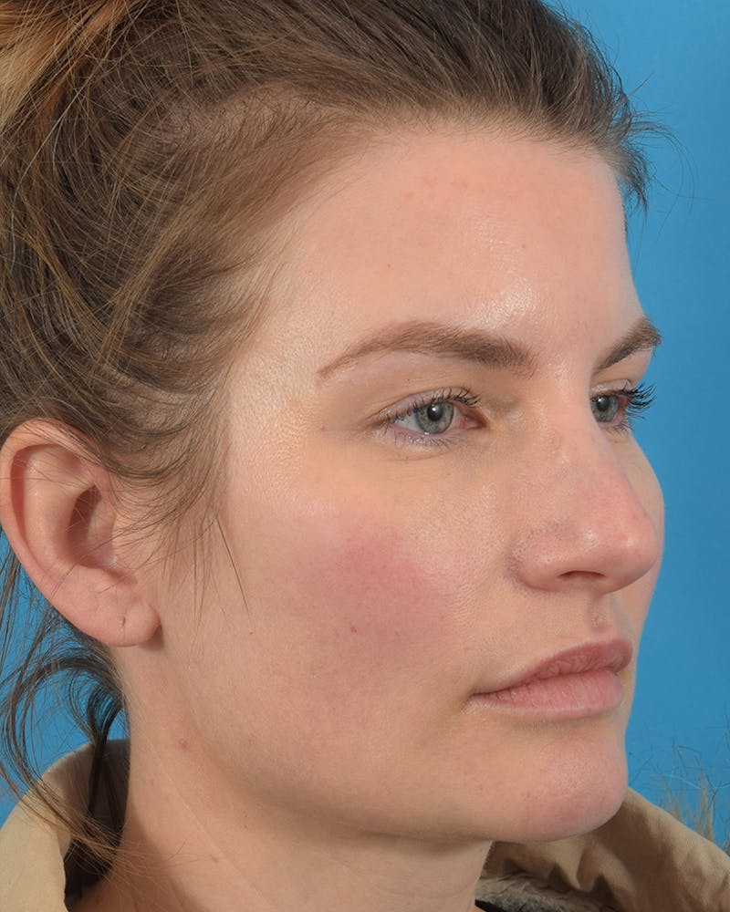 Rhinoplasty Before & After Gallery - Patient 62576199 - Image 3