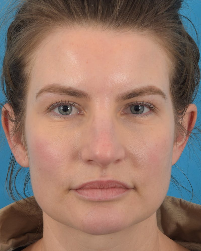 Rhinoplasty Before & After Gallery - Patient 62576199 - Image 5