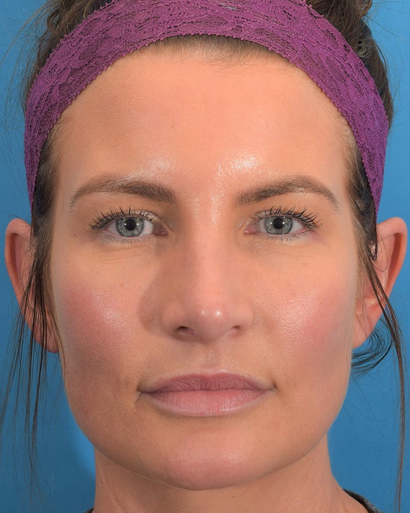 Rhinoplasty Before & After Gallery - Patient 62576199 - Image 6