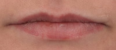 Lip Augmentation  Before & After Gallery - Patient 63105090 - Image 1