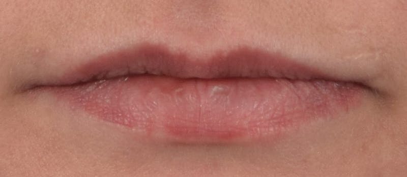Lip Augmentation  Before & After Gallery - Patient 63105090 - Image 1