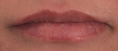 Lip Augmentation  Before & After Gallery - Patient 63105090 - Image 2