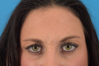 Botox Before & After Gallery - Patient 66233053 - Image 1