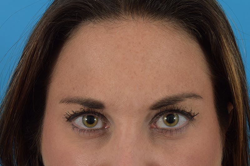 Botox Before & After Gallery - Patient 66233053 - Image 2